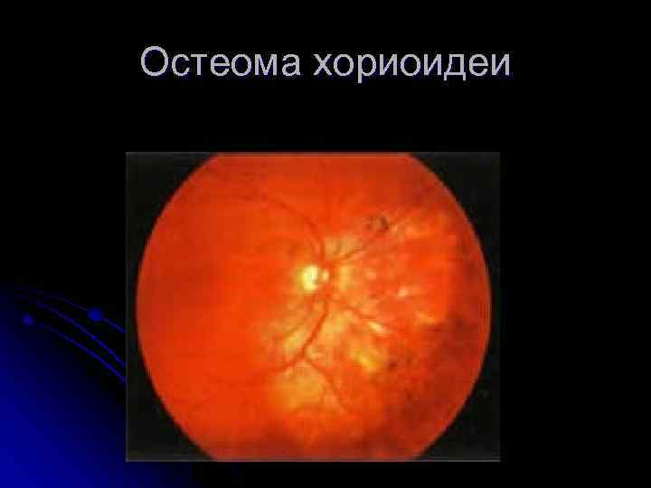Остеома хориоидеи 