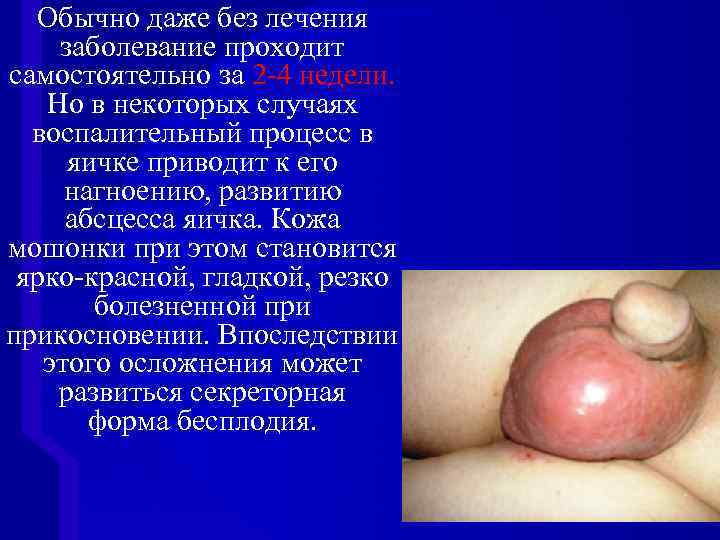 Обычно даже без лечения заболевание проходит самостоятельно за 2 -4 недели. Но в некоторых
