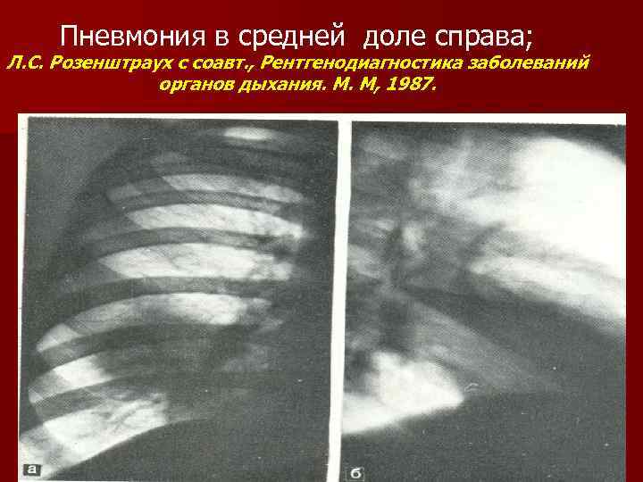 Пневмония в средней доле справа; Л. С. Розенштраух с соавт. , Рентгенодиагностика заболеваний органов