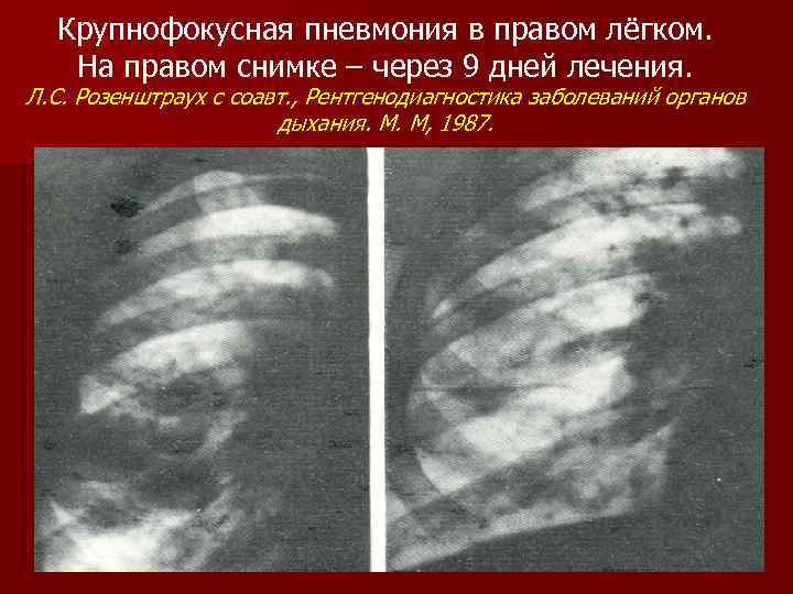 Крупнофокусная пневмония в правом лёгком. На правом снимке – через 9 дней лечения. Л.