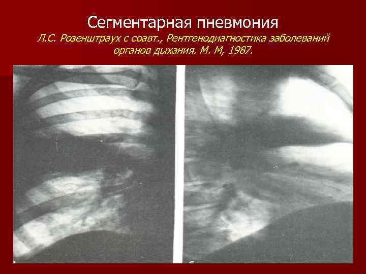 Сегментарная пневмония Л. С. Розенштраух с соавт. , Рентгенодиагностика заболеваний органов дыхания. М. М,
