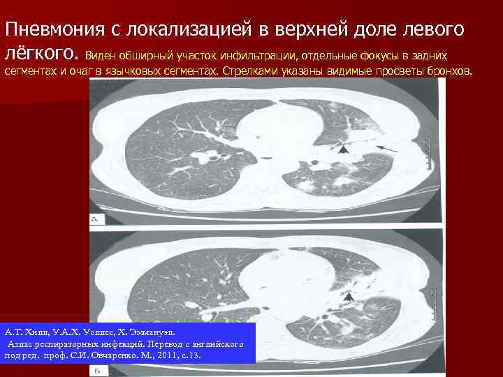 Пневмония с локализацией в верхней доле левого лёгкого. Виден обширный участок инфильтрации, отдельные фокусы