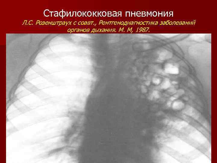 Стафилококковая пневмония Л. С. Розенштраух с соавт. , Рентгенодиагностика заболеваний органов дыхания. М. М,