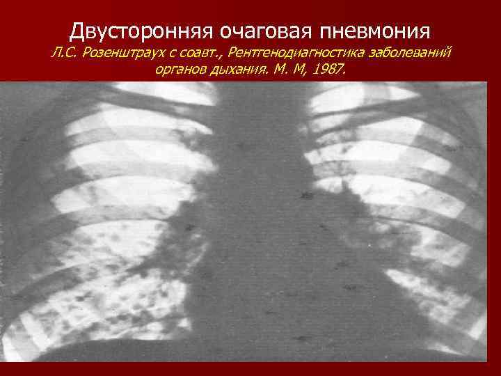 Двусторонняя очаговая пневмония Л. С. Розенштраух с соавт. , Рентгенодиагностика заболеваний органов дыхания. М.