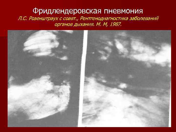 Фридлендеровская пневмония Л. С. Розенштраух с соавт. , Рентгенодиагностика заболеваний органов дыхания. М. М,