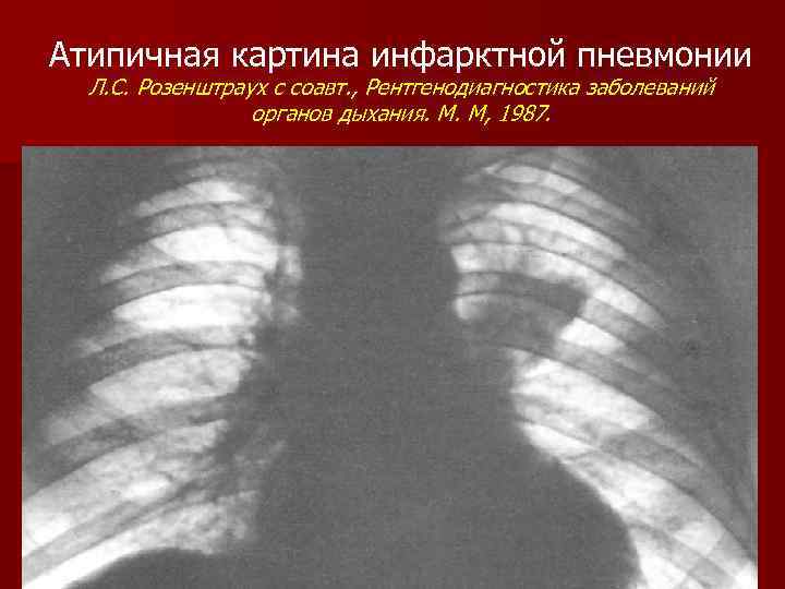 Атипичная картина инфарктной пневмонии Л. С. Розенштраух с соавт. , Рентгенодиагностика заболеваний органов дыхания.