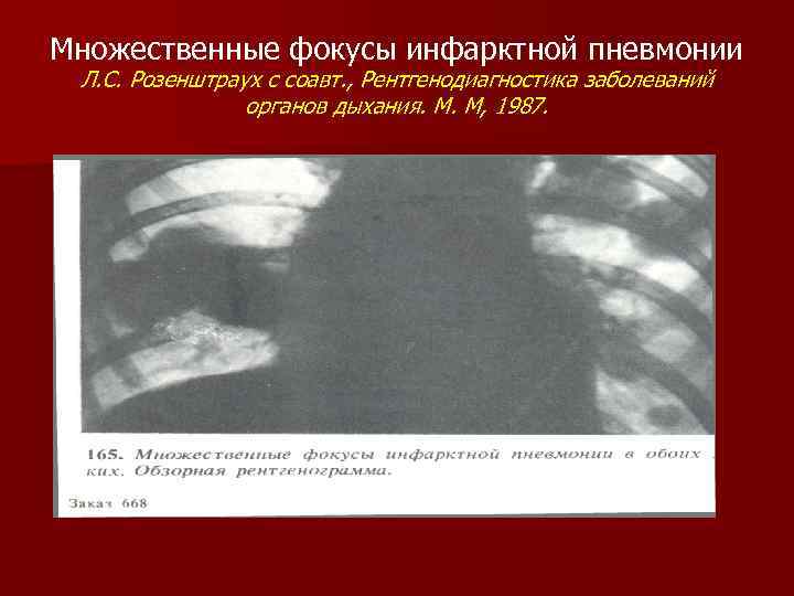 Множественные фокусы инфарктной пневмонии Л. С. Розенштраух с соавт. , Рентгенодиагностика заболеваний органов дыхания.