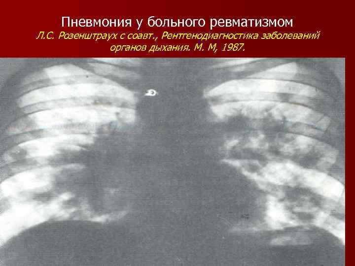 Пневмония у больного ревматизмом Л. С. Розенштраух с соавт. , Рентгенодиагностика заболеваний органов дыхания.