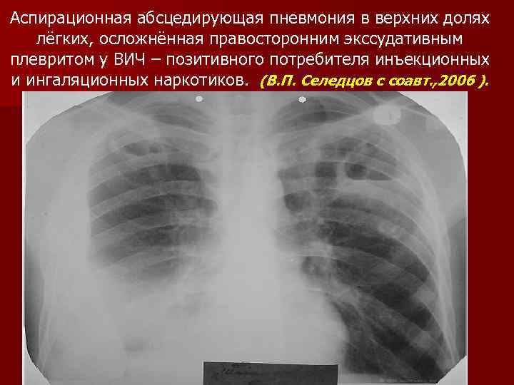 Аспирационная абсцедирующая пневмония в верхних долях лёгких, осложнённая правосторонним экссудативным плевритом у ВИЧ –