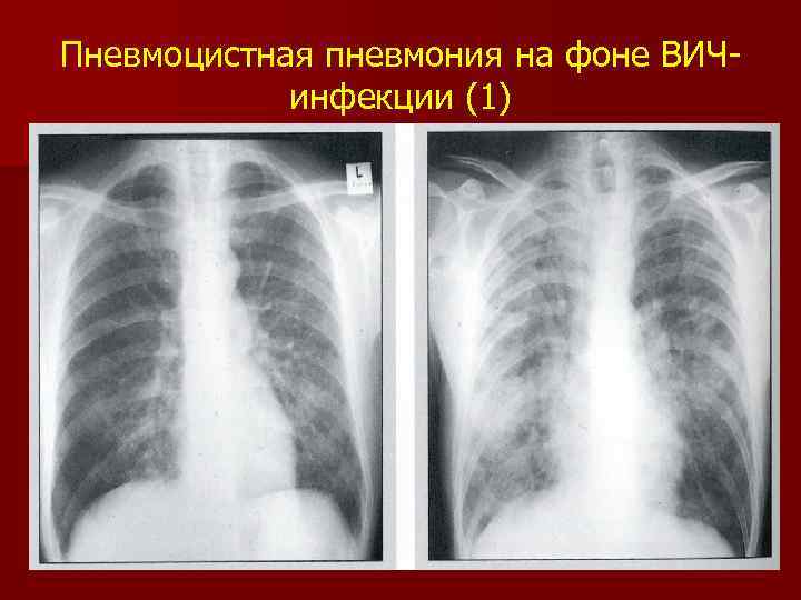 Пневмоцистная пневмония на фоне ВИЧинфекции (1) 