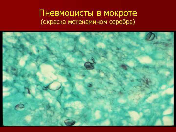 Пневмоцисты в мокроте (окраска метенамином серебра) 