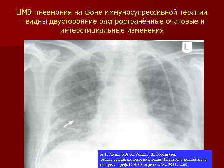 ЦМВ-пневмония на фоне иммуносупрессивной терапии – видны двусторонние распространённые очаговые и интерстициальные изменения А.