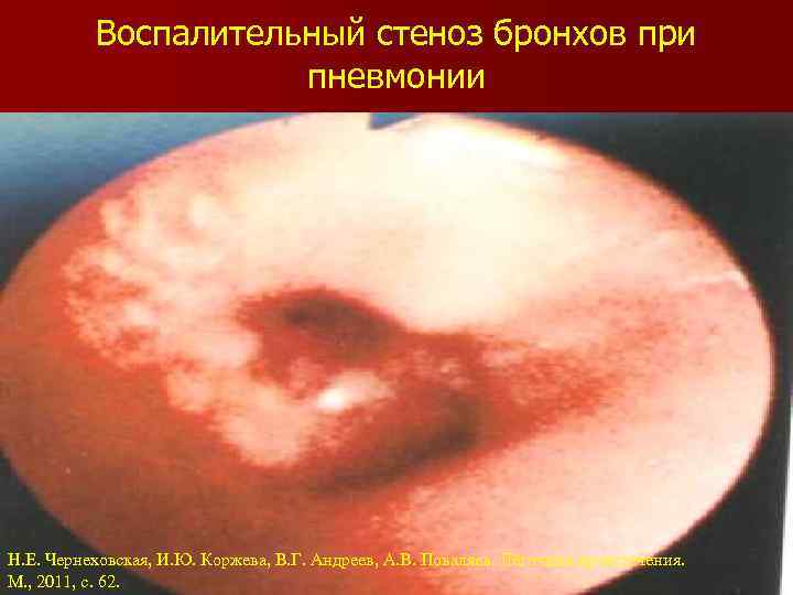 Воспалительный стеноз бронхов при пневмонии Н. Е. Чернеховская, И. Ю. Коржева, В. Г. Андреев,