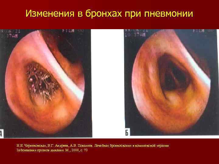 Изменения в бронхах при пневмонии Н. Е. Чернеховская, В. Г. Андреев, А. В. Поваляев.