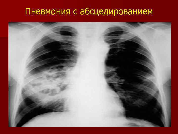 Пневмония с абсцедированием 