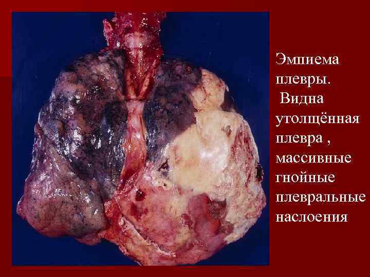 Абсцесс лёгкого Эмпиема плевры. Видна утолщённая плевра , массивные гнойные плевральные наслоения 