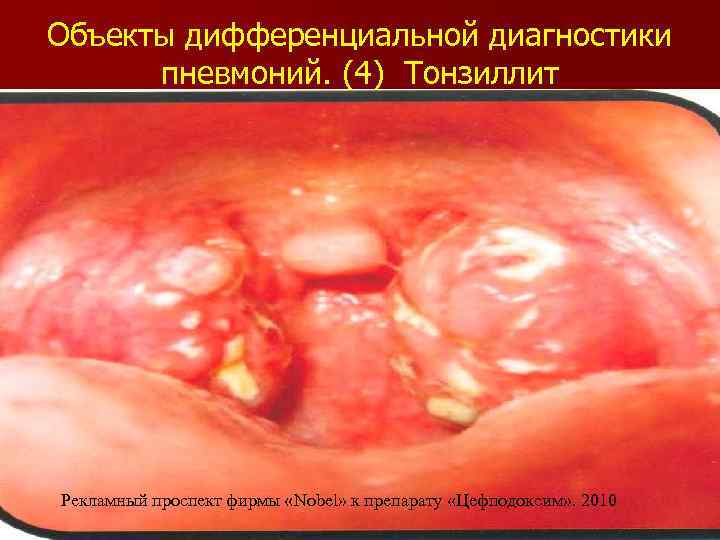 Объекты дифференциальной диагностики пневмоний. (4) Тонзиллит Рекламный проспект фирмы «Nobel» к препарату «Цефподоксим» .