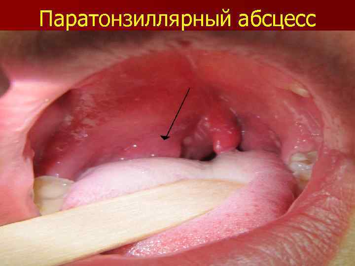 Паратонзиллярный абсцесс 