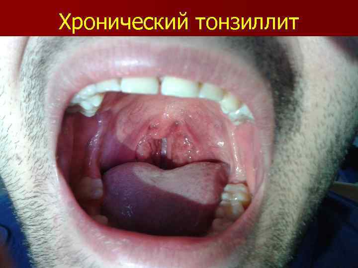 Хронический тонзиллит 