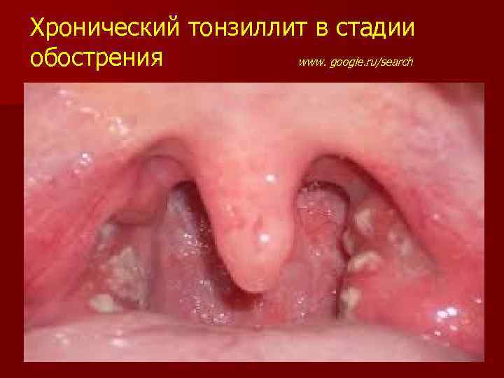 Хронический тонзиллит в стадии обострения www. google. ru/search 