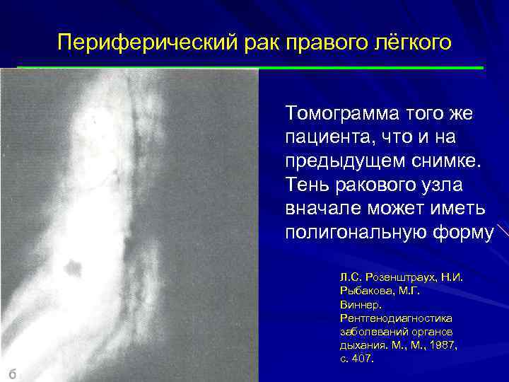 Периферический рак правого лёгкого Томограмма того же пациента, что и на предыдущем снимке. Тень