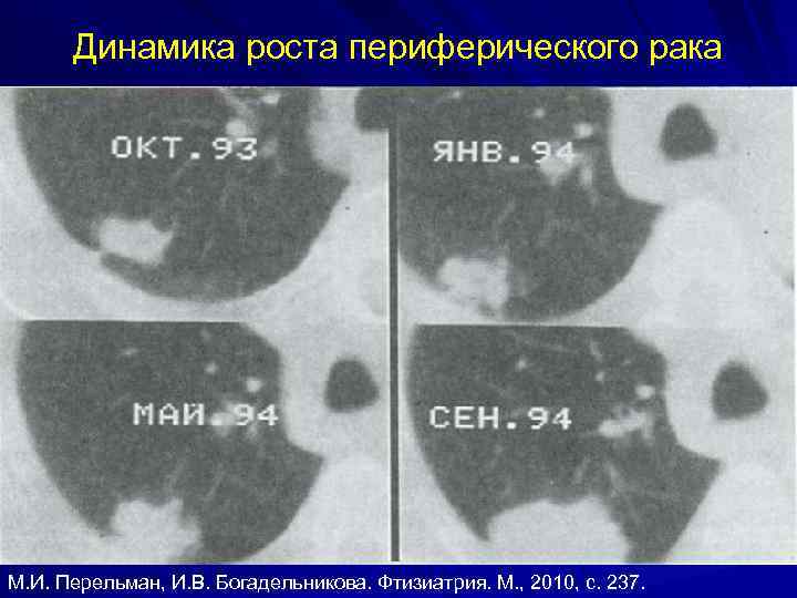 Динамика роста периферического рака М. И. Перельман, И. В. Богадельникова. Фтизиатрия. М. , 2010,