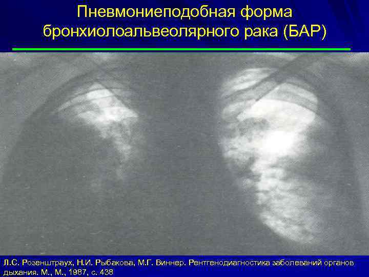 Пневмониеподобная форма бронхиолоальвеолярного рака (БАР) Л. С. Розенштраух, Н. И. Рыбакова, М. Г. Виннер.
