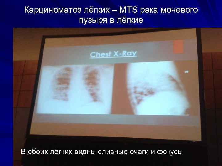Карциноматоз лёгких – MTS рака мочевого пузыря в лёгкие В обоих лёгких видны сливные