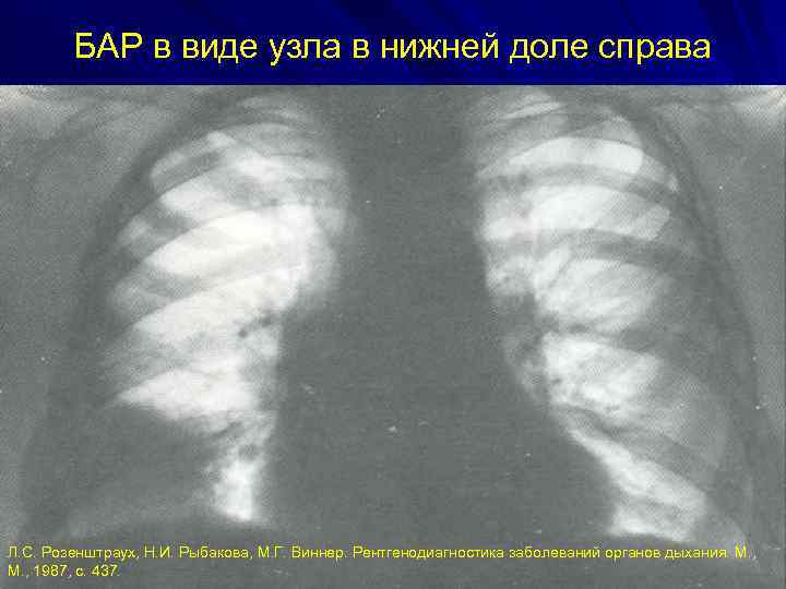 БАР в виде узла в нижней доле справа Л. С. Розенштраух, Н. И. Рыбакова,