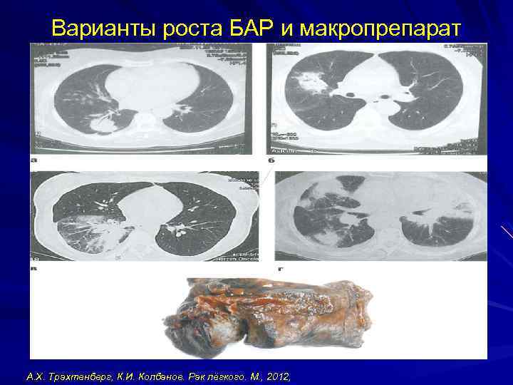 Варианты роста БАР и макропрепарат А. Х. Трахтенберг, К. И. Колбанов. Рак лёгкого. М.