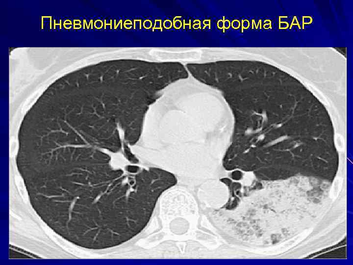 Бронхоальвеолярный рак презентация