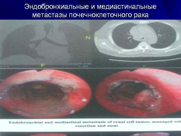 Эндобронхиальные и медиастинальные метастазы почечноклеточного рака 