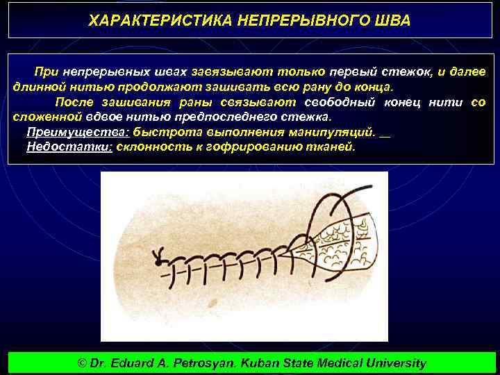 ХАРАКТЕРИСТИКА НЕПРЕРЫВНОГО ШВА При непрерывных швах завязывают только первый стежок, и далее длинной нитью