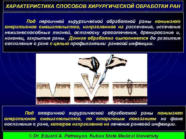 ХАРАКТЕРИСТИКА СПОСОБОВ ХИРУРГИЧЕСКОЙ ОБРАБОТКИ РАН Под первичной хирургической обработкой раны понимают оперативное вмешательство, направленное