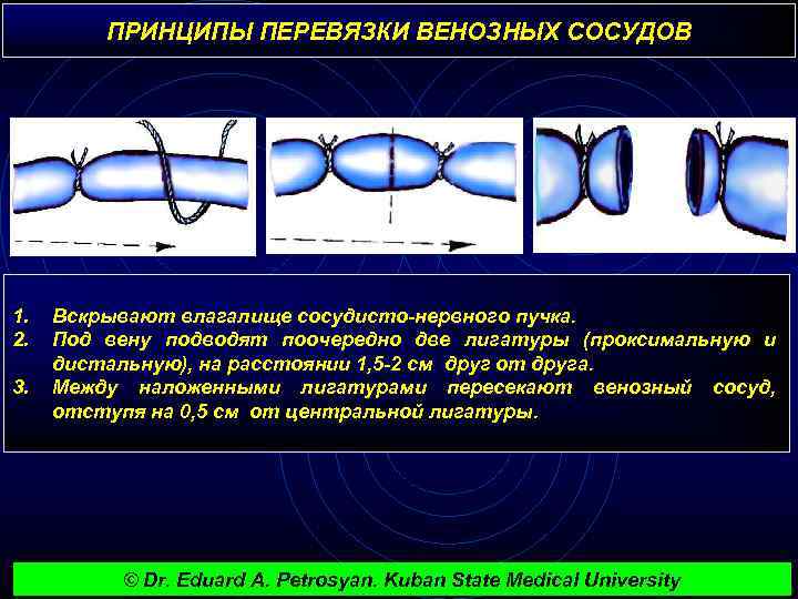 ПРИНЦИПЫ ПЕРЕВЯЗКИ ВЕНОЗНЫХ СОСУДОВ 1. 2. 3. Вскрывают влагалище сосудисто-нервного пучка. Под вену подводят