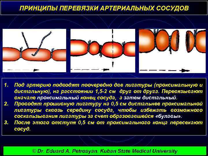ПРИНЦИПЫ ПЕРЕВЯЗКИ АРТЕРИАЛЬНЫХ СОСУДОВ 1. 2. 3. Под артерию подводят поочередно две лигатуры (проксимальную