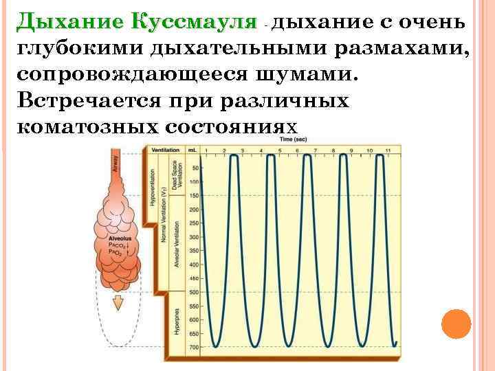 Дыхание Куссмауля - дыхание с очень глубокими дыхательными размахами, сопровождающееся шумами. Встречается при различных