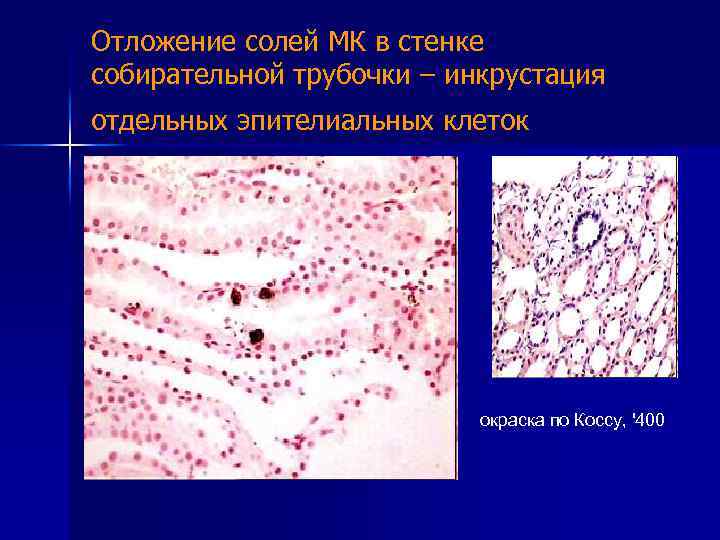 Отложение солей МК в стенке собирательной трубочки – инкрустация отдельных эпителиальных клеток окраска по