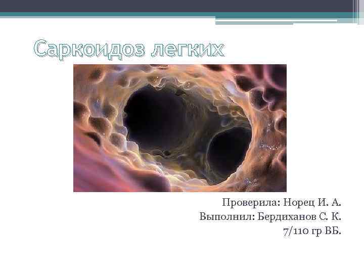 Саркоидоз легких Проверила: Норец И. А. Выполнил: Бердиханов С. К. 7/110 гр ВБ. 