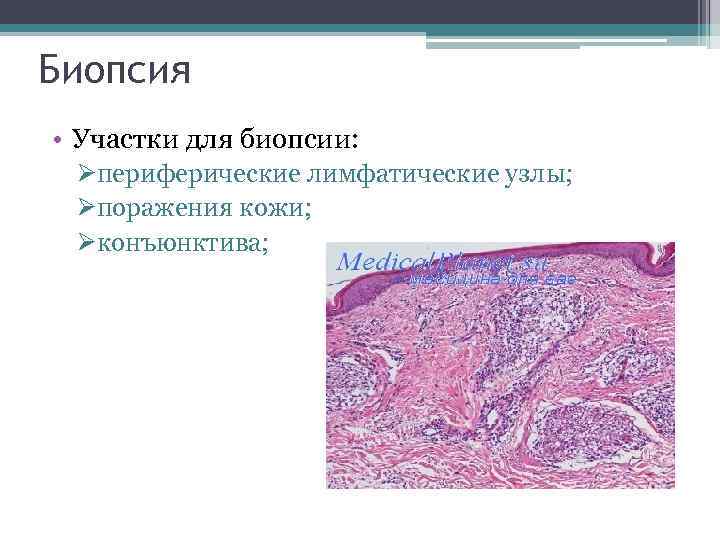 Биопсия • Участки для биопсии: Øпериферические лимфатические узлы; Øпоражения кожи; Øконъюнктива; 