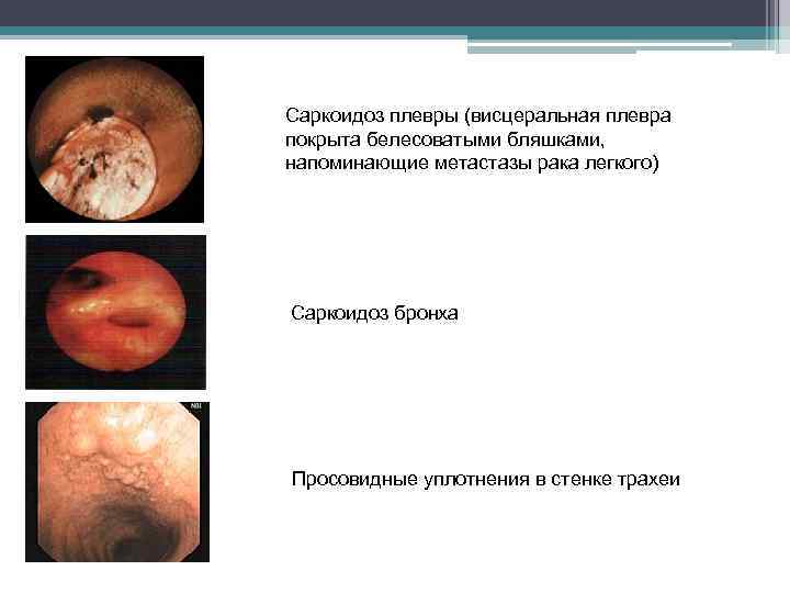 Саркоидоз плевры (висцеральная плевра покрыта белесоватыми бляшками, напоминающие метастазы рака легкого) Саркоидоз бронха Просовидные