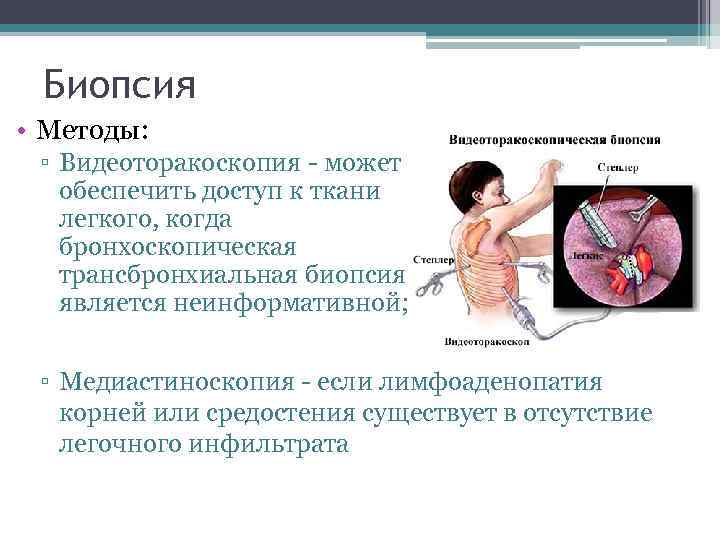 Биопсия • Методы: ▫ Видеоторакоскопия - может обеспечить доступ к ткани легкого, когда бронхоскопическая