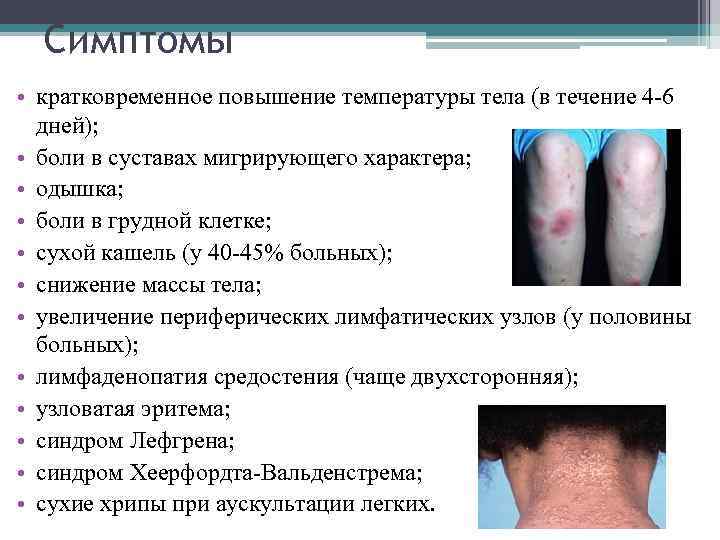 Симптомы • кратковременное повышение температуры тела (в течение 4 -6 дней); • боли в
