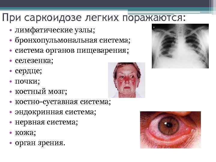 При саркоидозе легких поражаются: • • • лимфатические узлы; бронхопульмональная система; система органов пищеварения;