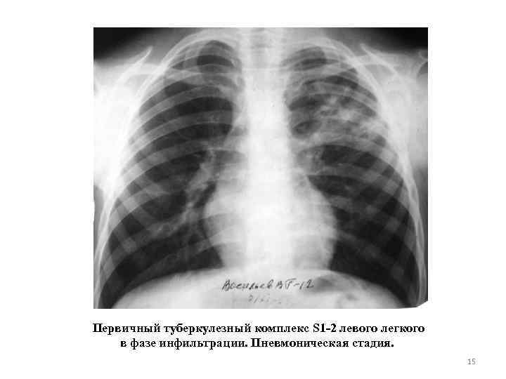 Первичный туберкулезный комплекс S 1 -2 левого легкого в фазе инфильтрации. Пневмоническая стадия. 15