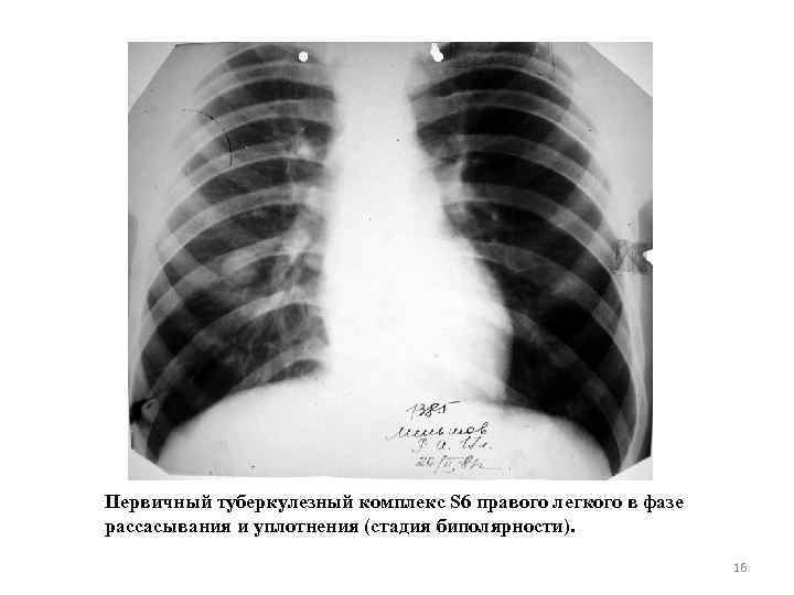 Первичный туберкулезный комплекс S 6 правого легкого в фазе рассасывания и уплотнения (стадия биполярности).