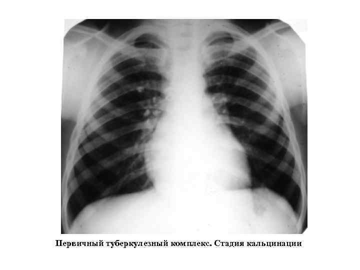 Первичный туберкулезный комплекс. Стадия кальцинации 
