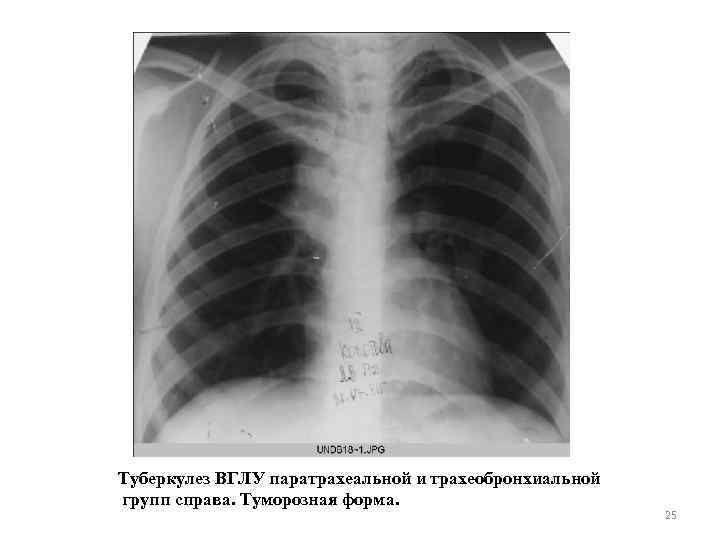 Туберкулез ВГЛУ паратрахеальной и трахеобронхиальной групп справа. Туморозная форма. 25 