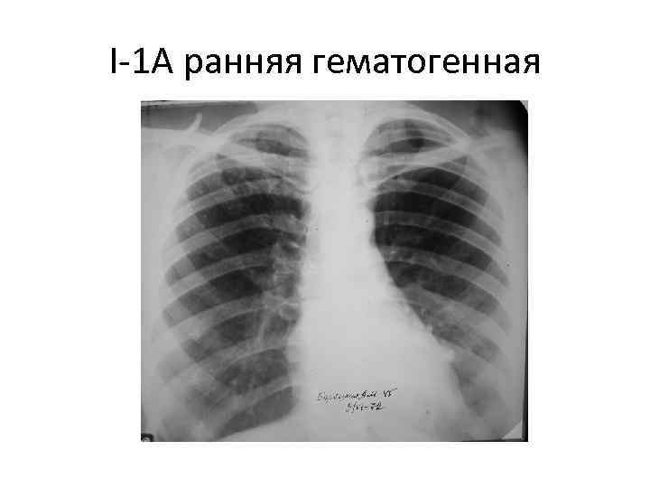 I-1 A ранняя гематогенная 