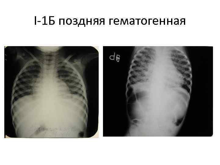 I-1 Б поздняя гематогенная 